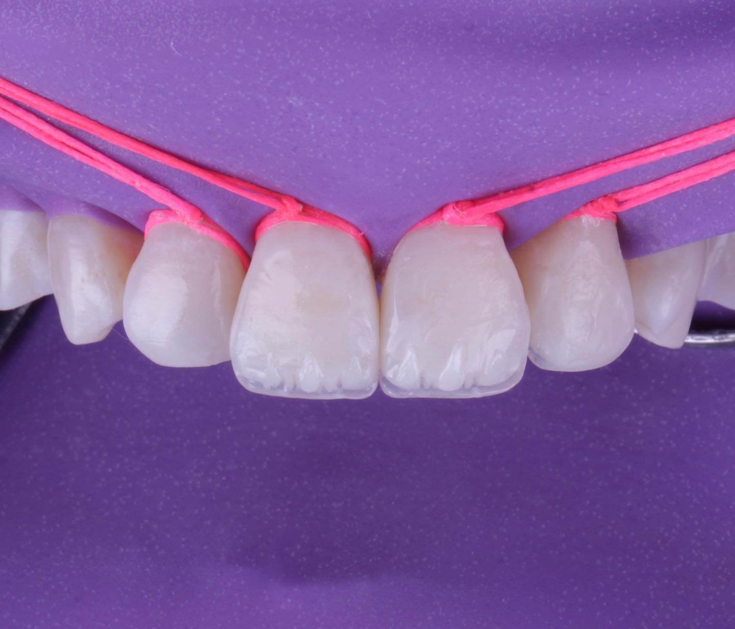 Caso Clínico 4 - Sorriso Natural