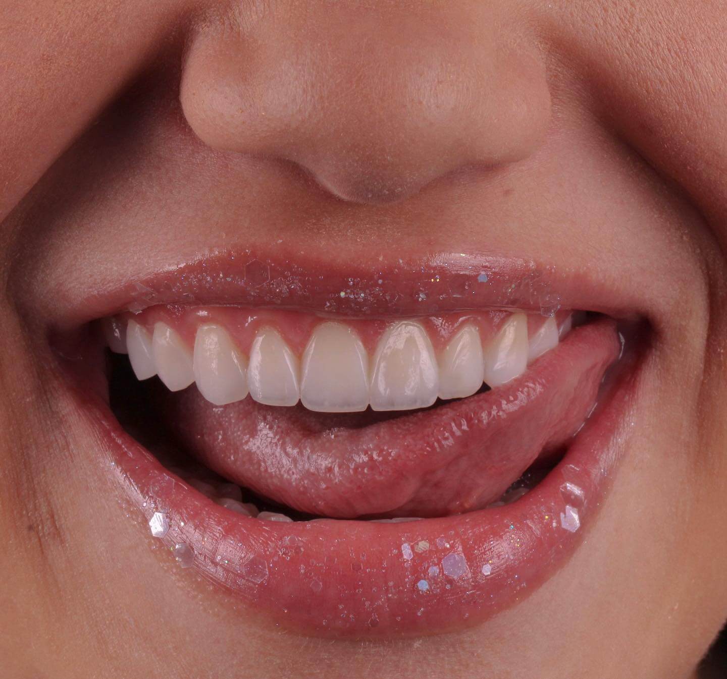 Caso Clínico 5 - Estratificação