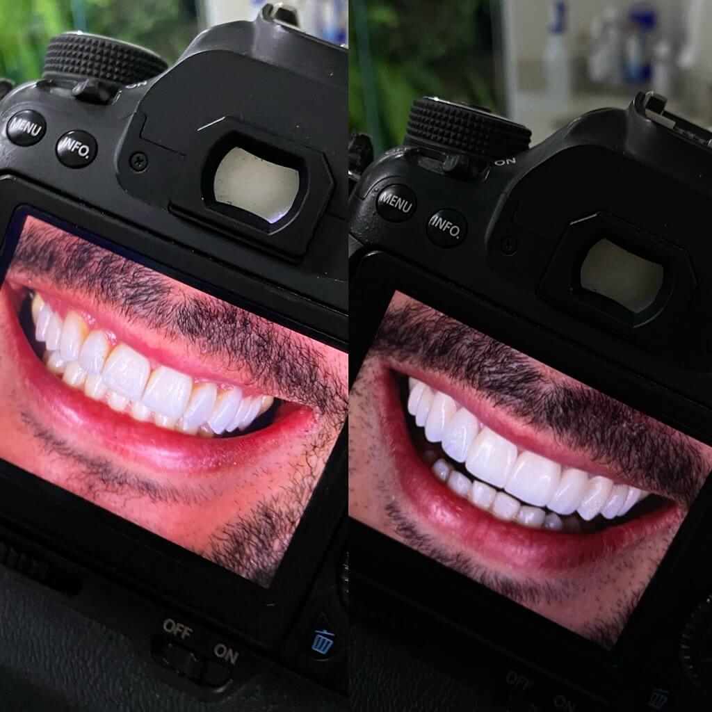 Caso Clínico 7 - Detalhe Incisal