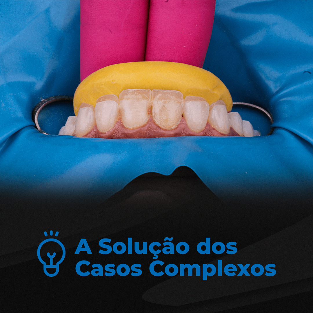 Estratificação Camada a Camada